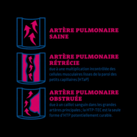 traitement hypertension pulmonaire